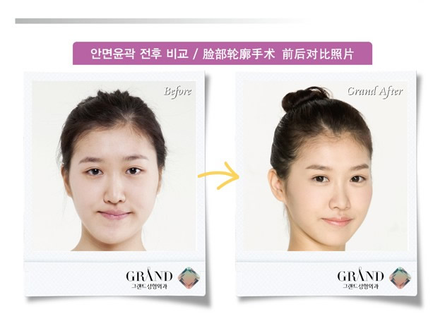 颧骨整形能决定人的年龄吗