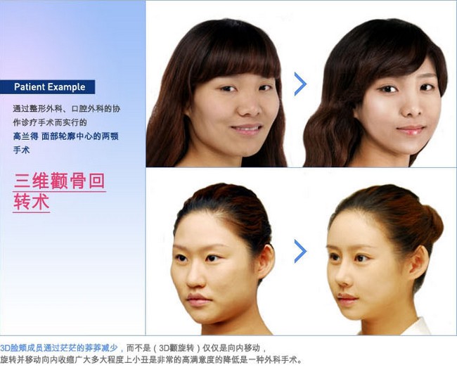 三维颧骨旋转术手术对比图