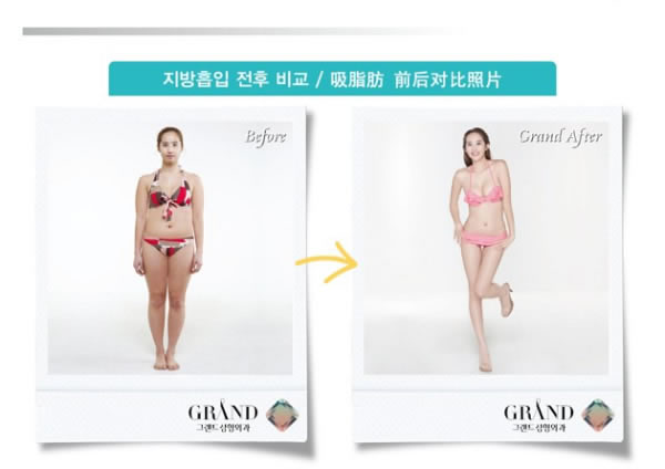 高兰得整形外科吸脂塑形对比案例