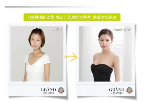 高兰得整形外科胸部扩大手术对比案例