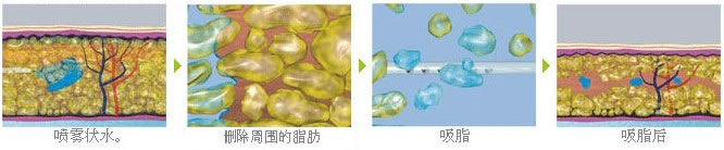 Waterjet抽脂的原则
