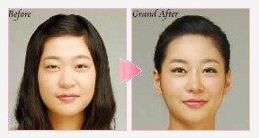 眼睛、鼻子整形术前后对比照片