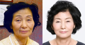 最小切开颜面提升术前后对比照片