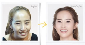 面部轮廓整形前后对比照片