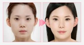 自然粘连法双眼皮手术前后对比照片 